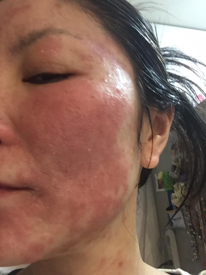 顔の皮膚がただれて痛く痒い ムーンフェイスで社会で生きられないくらいの状態が 日本5感育協会
