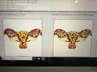 メタトロンさん卵管炎を的中